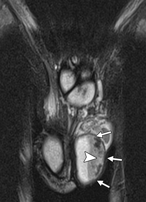 Spectrum Of Extratesticular And Testicular Pathologic Conditions At Scrotal Mr Imaging