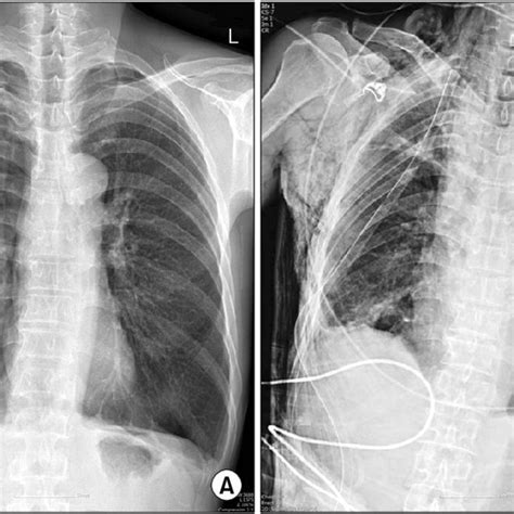 A A Preoperative Chest X Ray Showed A Large Amount Of Right