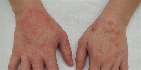 Dermatite Da M O Eczema Das M Os Puromd