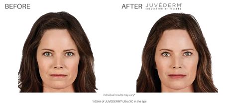 Juvéderm Before And After Real Patient Results Newport News Va