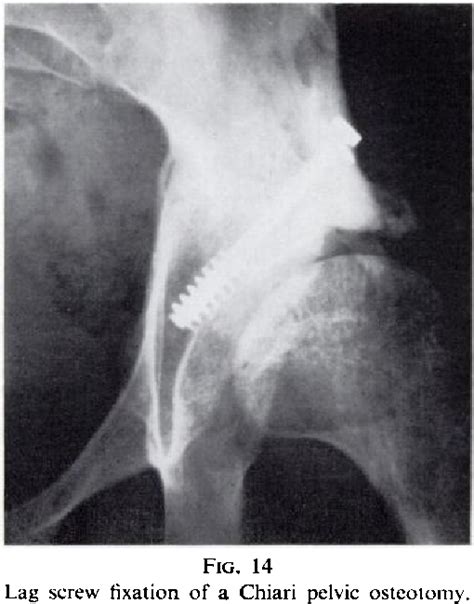 Figure 14 From Chiari Osteotomy For Acetabular Dysplasia In Young