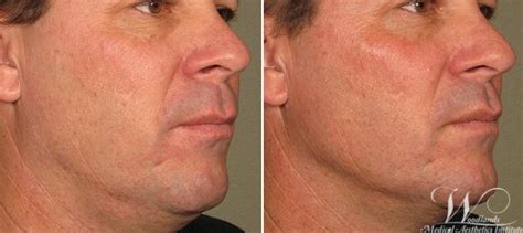 Ultherapy® Skin Tightening Before And After Photo Gallery The