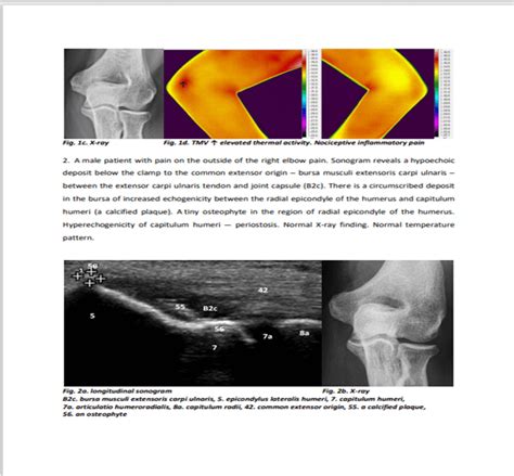 Sonographic And Thermographic Findings Of The Elbow Clinical Practise