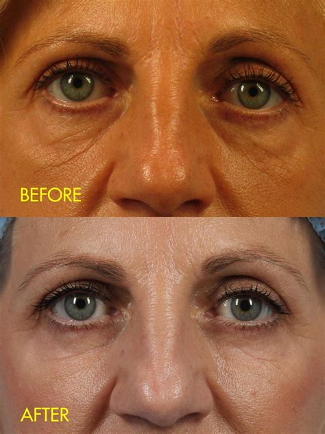Under Eye Fat Injections Do They Work