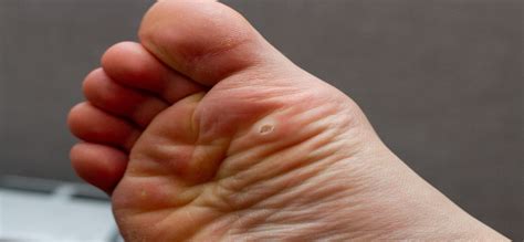 How To Put Plantar Warts In Your Past And Keep Them Out Of Your Future