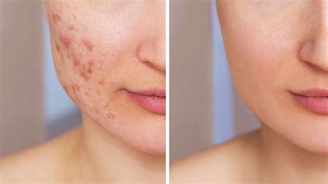 Adult Acne Dermatologists Explain Acne Treatments And Reveal More About The Skin Condition