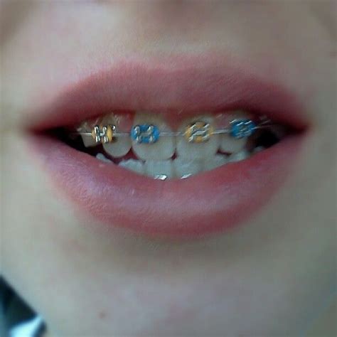 Braces Colors Blue And Yellow Cleaneatingx11
