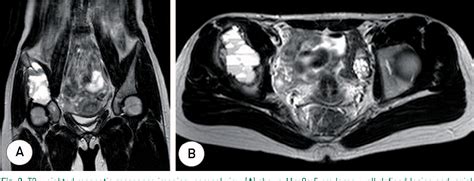 Figure 1 From Primary Aneurysmal Bone Cyst In The Iliac Bone A Case