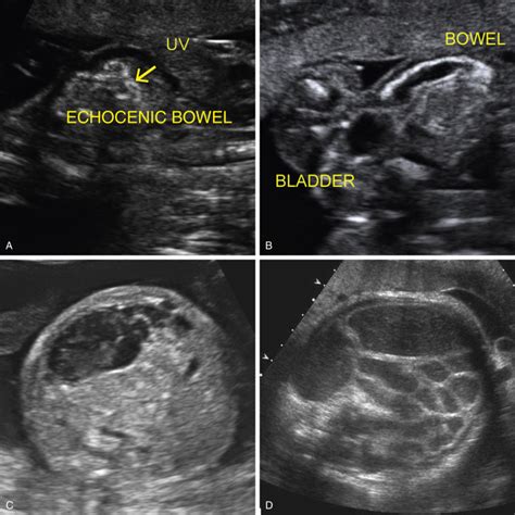 Ultrasound Evaluation Of The Fetal Gastrointestinal Tract And Abdominal
