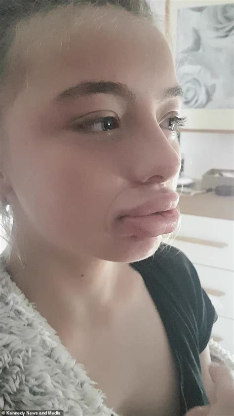 Mother In Stitches As Teenage Daughter Gets Stuck With Duck Lips For