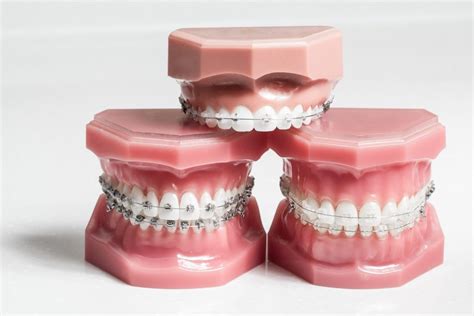 Orthodontic Braces Buying Guide Glenn Carty Orthodontist