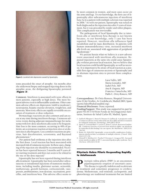 Pityriasis Rubra Pilaris Responding Rapidly To Adalimumab Dermatology