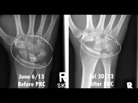 Proximal Row Carpectomy - PRC | From a patient's point of view