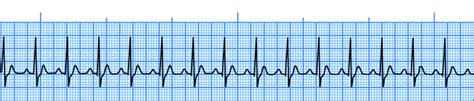 Ecg Interpretation Diagnose Any Cardiac Rhythm Nurse Your Own Way