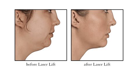 Laser Lift Facelift Alternative Cosmetic Skin Laser Center