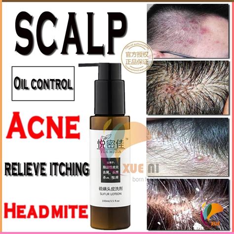 Scalp Folliculitis Red And Swollen Acne Anti Dandruff And Antiitchy