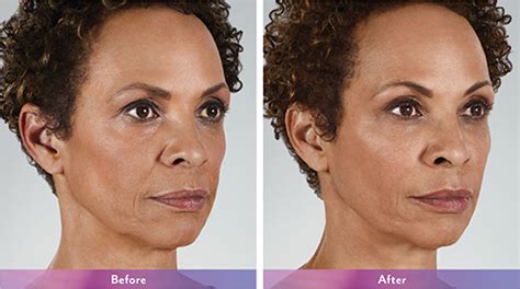 Nasolabial Folds Before And After Juvederm Voluma Lookyoungernews