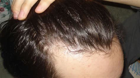 What Is The Cause Of A Receding Hairline