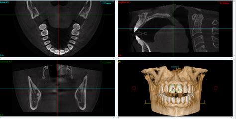 Why We Use Cone Beam Cbct For Diagnosis And Root Canal Treatment
