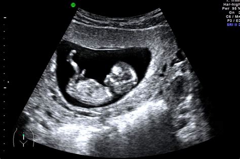 We are pleased to offer the latest technology and offer 3d and 4d scanning to our patients. Early Pregnancy Scan / Dating Scan - Safehands Medical Centre