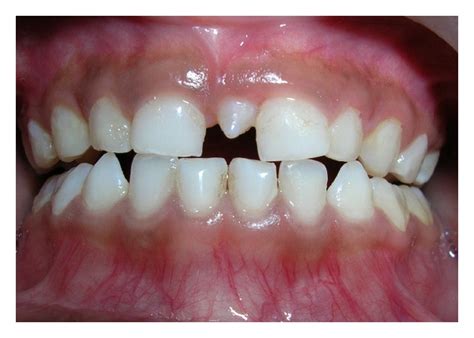 Tooth 61 and mesiodens was extracted under local anesthesia. Supernumerary Teeth in Primary Dentition and Early ...