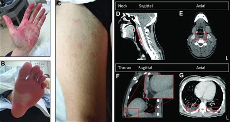 A Multiple Sharply Demarcated Erythematous Papules And Plaques On The