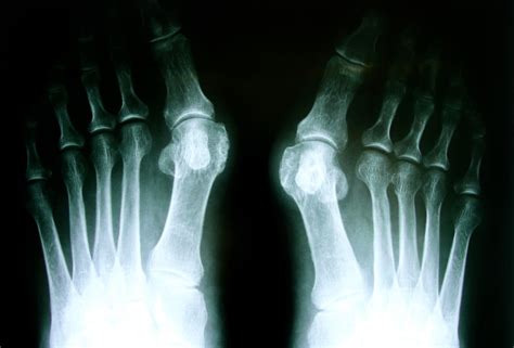 Bunion Surgery And Treatment Get Rid Of Bunion Pain Perth Foot Centre