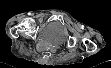 Incarcerated Obturator Hernia Presenting With Acute Abdomen