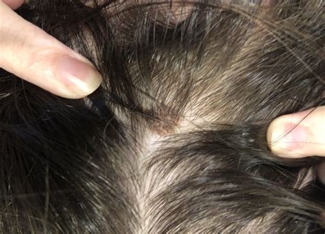 Skin Cancer Spots On Scalp