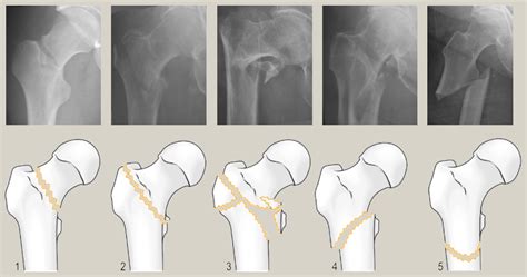Hip Fractures In Young Adults Orthopaedics And Trauma