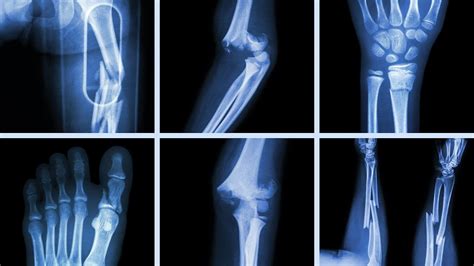 What Happens To Your Body When You Break A Bone In 2020 Heal Broken