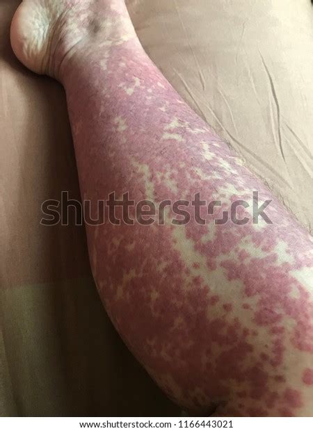 Henochschonlein Purpura Hsp Disease Involving Inflammation Stock Photo