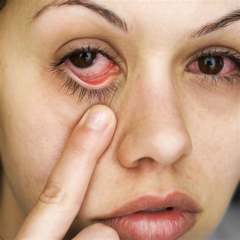 Mandeville LA Conjunctivitis FAQ Pink Eye Causes Symptoms Treatments