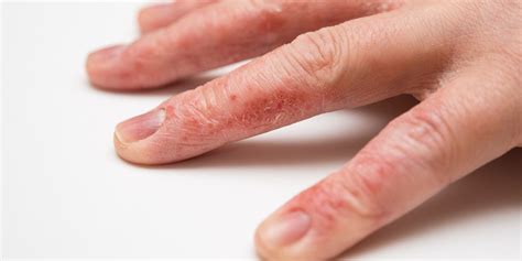 In addition to wearing gloves when doing the dishes or cooking, make sure you're applying moisturizer to. Hand Eczema: 8 Ways to Deal With This Frustrating ...