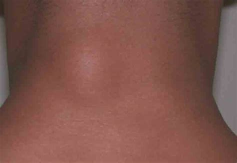 Causes For Lump On The Back Of Neck