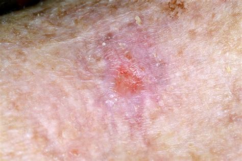 Basal Cell Carcinoma Skin Cancer Stock Image C0284466 Science