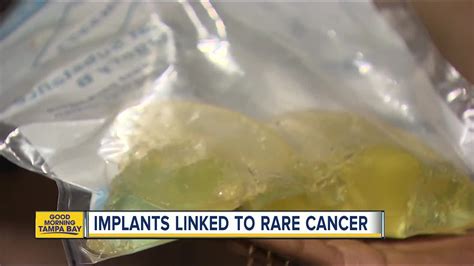 Fda Rare Cancer Linked To Breast Implants