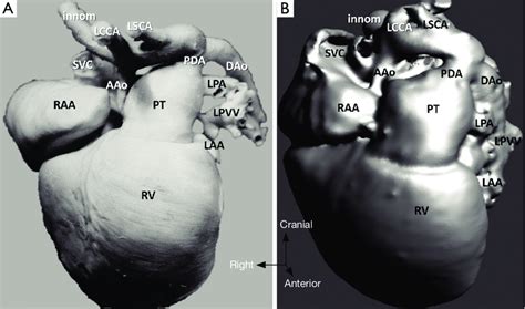 Hypoplastic Left Heart Syndrome Case 5 A Cardiac Specimen B 3d