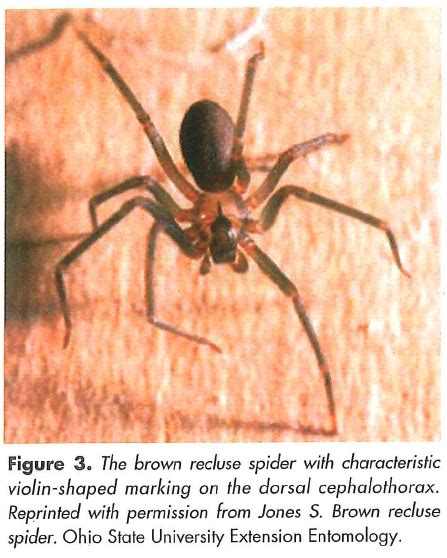 Brown Recluse Spider Bite A Rare Cause Of Necrotic Wounds