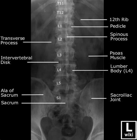 Lumbar Spine Radiographic Anatomy Radiology Student Diagnostic