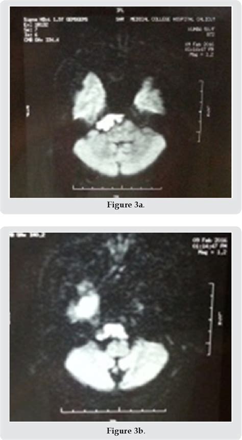 Figure 3 From A Cerebellopontine Angle Epidermoid Cyst Presenting As