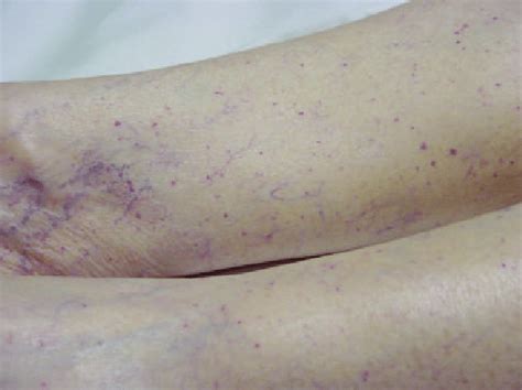 Typical Petechial Rash On Patients Lower Extremities Download
