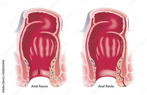 Medical Illustration Shows Two Common Anal Disorders An Anal Fissure