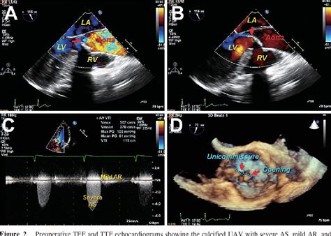 Figure 2 From Assessment Of Unicuspid Aortic Valve Stenosis Using
