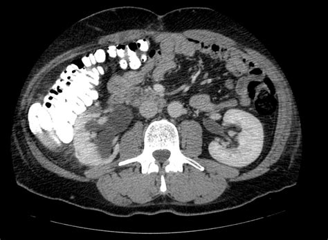 Pyelonephritis Ct Scan Wikidoc