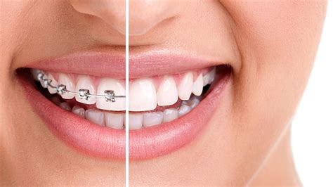 getting your braces off here s what to expect college drive dental associates