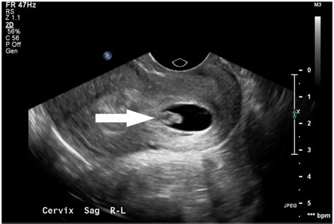 Didelphys Uterus Ultrasound