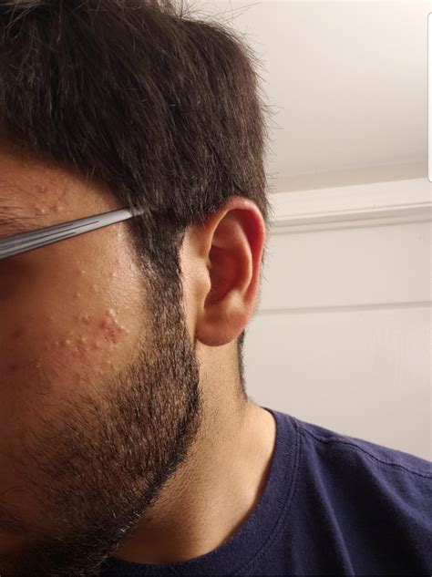 Help Please How Do I Get Rid Of These Bumpsred Spots On Cheeks Racne