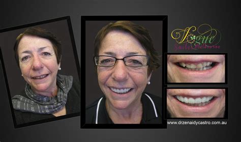 Pin On Before And After Cosmetic Smile Makeover Melbourne