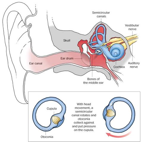 When a cause can be determined, bppv is frequently related to a small to extreme blow to your head. Vertigo article in Washington Post | Vertigo, Dizziness ...